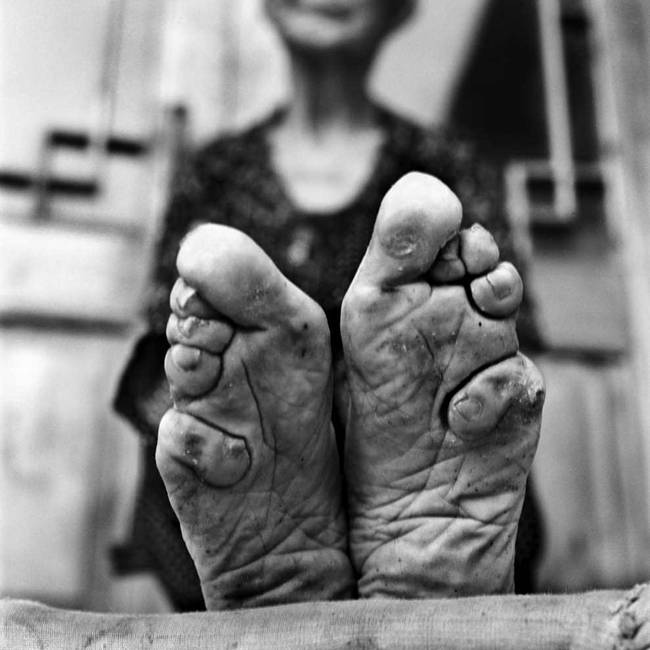 Chinese women have experienced the painful procedure of foot-binding