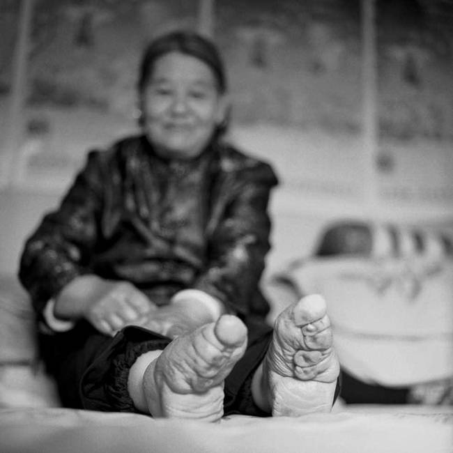 Chinese women have experienced the painful procedure of foot-binding